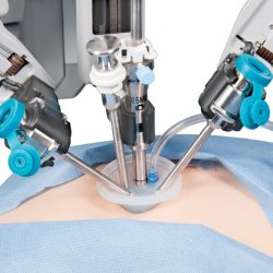 Laparoszkópia, hastükrözés és távműtét