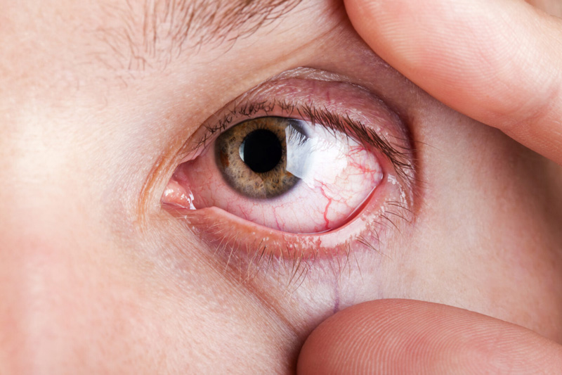 száraz szem izületi fájdalom súlyos ízületi fájdalmak kezelése